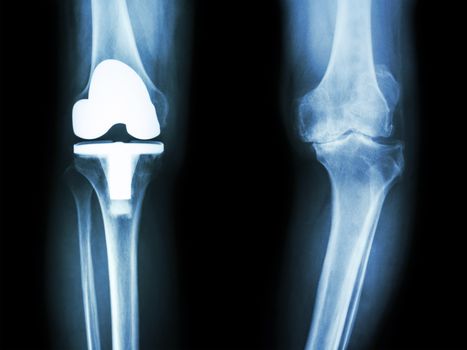 film x-ray knee of osteoarthritis knee patient and artificial joint