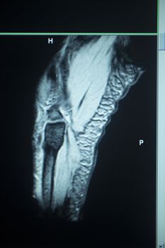 MRI scan test results elbow arm injury