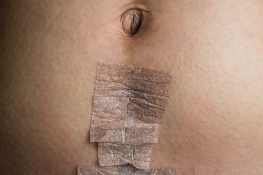 Cesarean Section Scar covered with Medical Tape