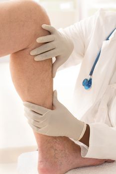 Variscose veins on a male leg
