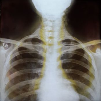 Chest X-Ray Scanning