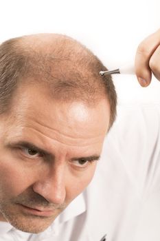 Baldness Alopecia man hair loss haircare 