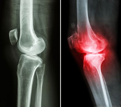 normal knee ( left image ) and osteoarthritis knee ( right image ) ( lateral view )