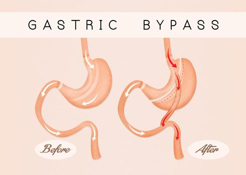 before and after gastric bypass
