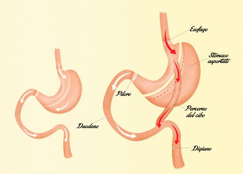 illustration of gastric bypass