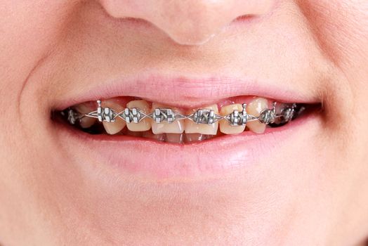 Closeup picture of the teenage girl with braces on her teeth.