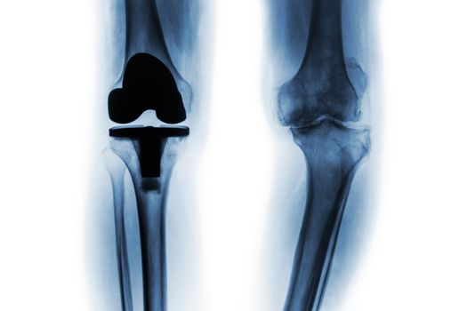 Film x-ray of osteoarthritis knee patient and artificial joint ( Total knee replacement ) . Isolated background .