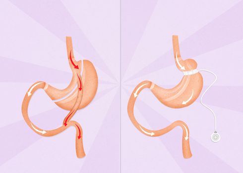 gastric bypass and gastric band surgery