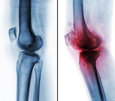 Comparison between normal human knee ( left image ) and osteoarthritis knee ( right image ) . Lateral view