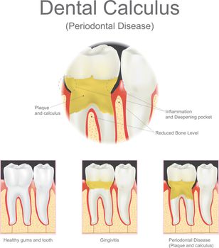 Dental calculus periodontal disease.