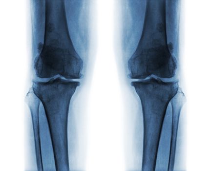 Osteoarthritis both knee .