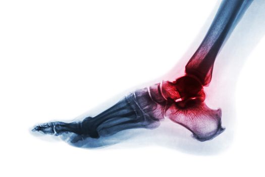 Arthritis of ankle . X-ray of foot . Lateral view . Invert color style . Gout or Rheumatoid concept