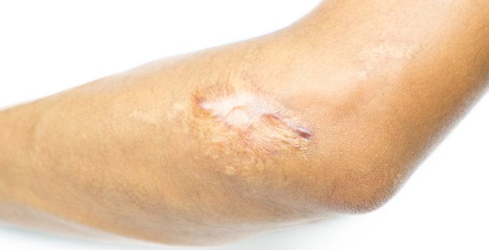 Closeup keloid scar on elbow of Asian man skin after motorcycle accident on white background with copy space.