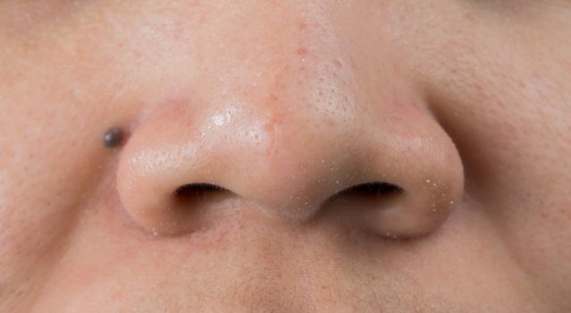 Blackheads acne on Asian woman nose. Scar on tip of nose. Open comedones and large pores skin need AHA, BHA or benzoyl peroxide for treatment.
