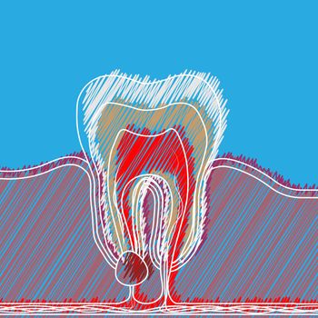 Stylized hatching of dental disease with a point of pain and inflammation. Medical illustration of tooth root inflammation, tooth root cyst, pulpitis.