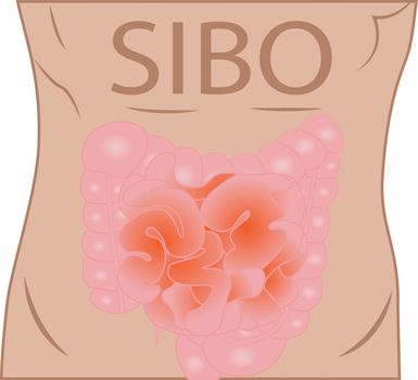 Small Intestinal Bacterial Overgrowth - SIBO.