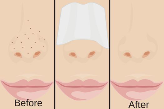 Blackheads on Nose and treatment