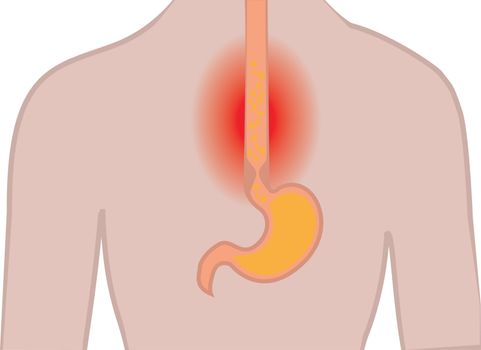Gastroesophageal reflux disease. Heartburn Gerd stomach in a human body