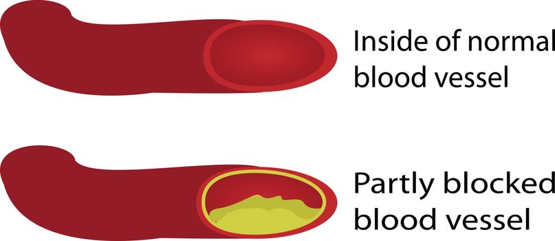 Healthy and blocked blood vessels