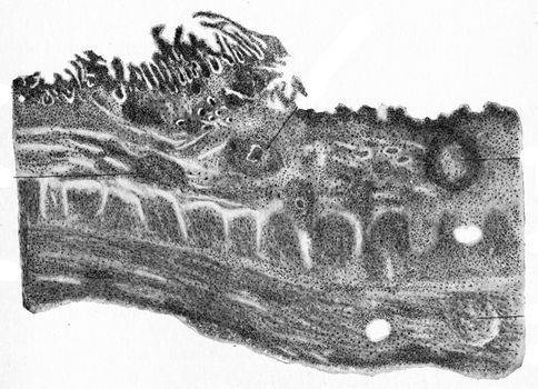 Margin of tubercular ulcer of the intestine, vintage engraving.