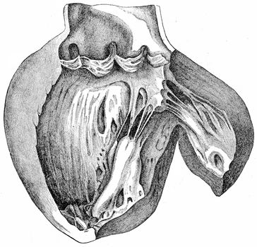 Heart with left ventricle laid open, showing the aortic cusps an