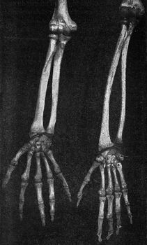 Skeleton of the forearm and hand of a Japanese and an Australian