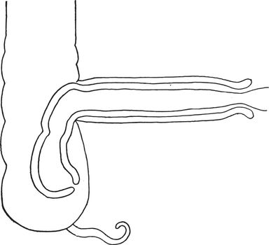 Intussusception diagram intended to show the relation of the sev