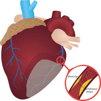 Blood clot  cholesterol plaque in artery Heart attack