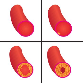 Levels of cholesterol plaque in vessels