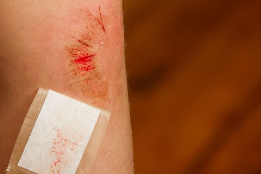 Young girl fell while riding a bike causing a large abrasion to her knee that she bandaged up