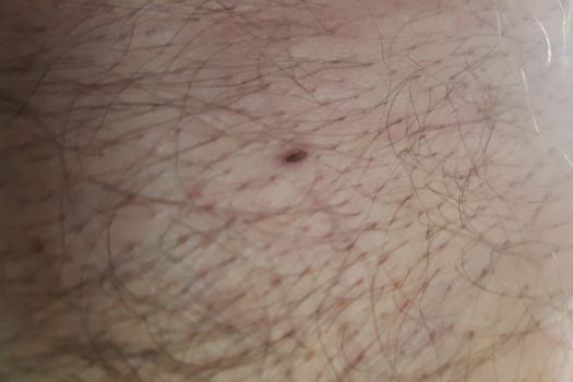 Close-up of a little deer tick on the human skin.