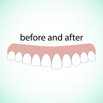 Dental restoration illustration vector on blue background. Dental concept.