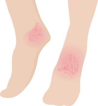 Eczema affected a foot Dermatology skin disease