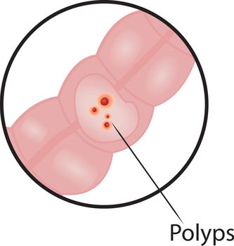 Polyps in  intestine colon disease