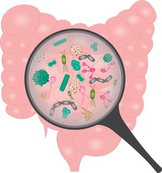 Bacterial overgrowth in small intestine