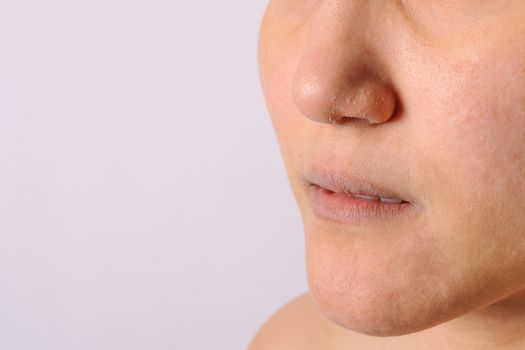 Allergic women have eczema dry nose and lips on winter season cl