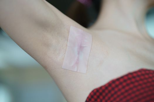 Paste a medical silicone sheet To treat the keloids scar on the 