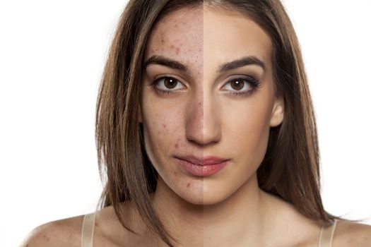 portrait of a woman with problematic skin without and with makeu