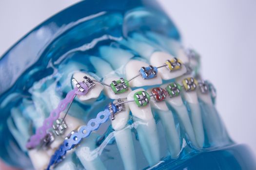 Classic dental metal orthodontics with colored hooks