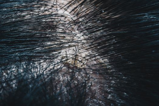 Hair scalp with dandruff and scaly from psoriasis