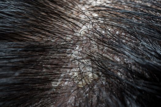 Hair scalp with dandruff and scaly from psoriasis