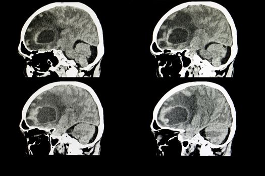 metastatic brain tumor 