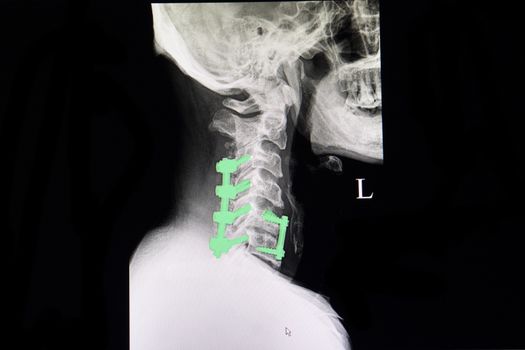 Rods and screws fixation along C3-C6