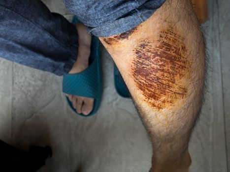 Man with scab wound on his  leg