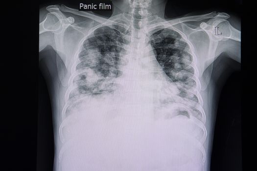 metastatic carcinoma of the lungs