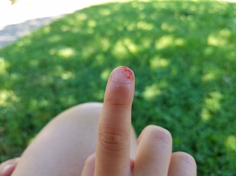 child's fingernail with blood