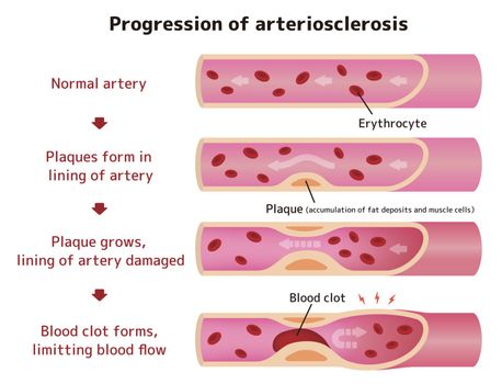 Progression of arteriosclerosis illustration