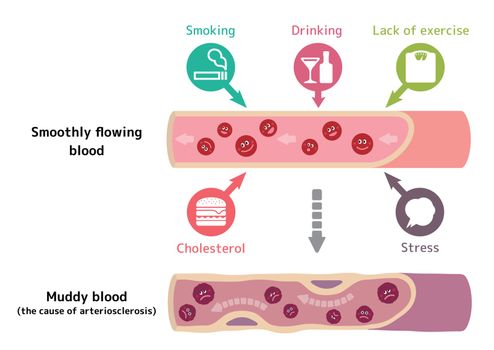 Illustration that healthy blood become muddy blood due to various unhealthy factors, causing arteriosclerosis