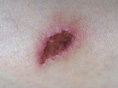 abrasion scar tissue