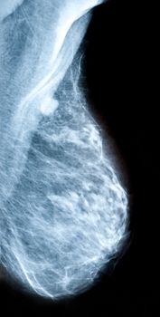 Screening for breast cancer - radiology